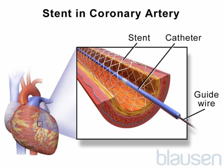 관상동맥질환(Coronary Artery Disease) 개요