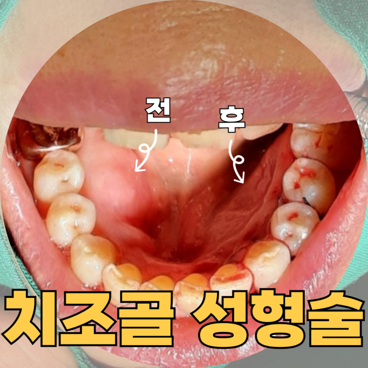  천안구강외과 치조골성형술