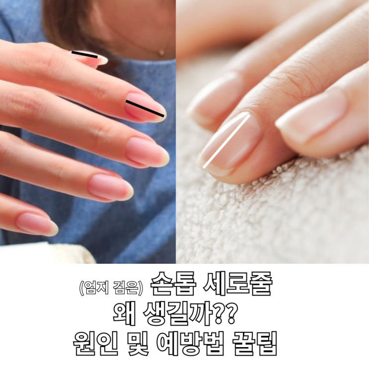  검은 손톱 세로줄 원인 및 예방법 총정리
