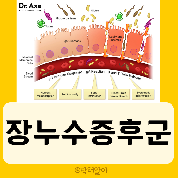  장누수증후군 (Leaky gut syndrome) 의 정의, 원인, 증상, 진단 및 치료