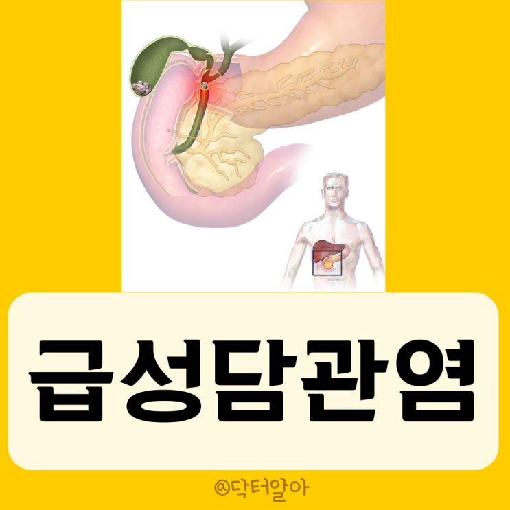  급성 담관염(Acute cholangitis)의 정의, 원인, 증상, 진단 및 치료