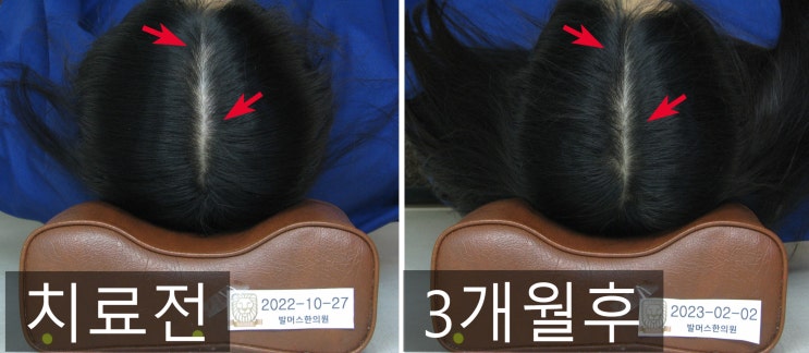  10대에게도 탈모가? 청소년 탈모, 왜 생기고 어떻게 치료해야 할까?