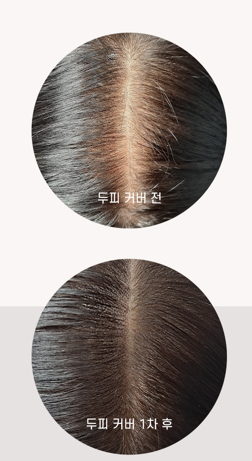  두피도 채우고 자존감도 채우는 두피문신