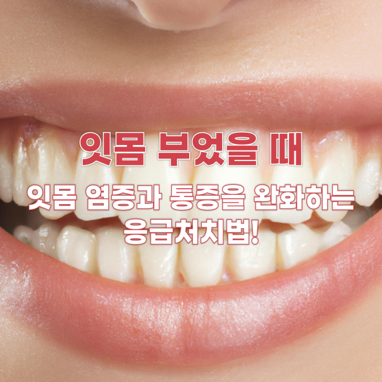 잇몸 부었을 때, 잇몸 염증과 통증을 완화하는 응급처치법!