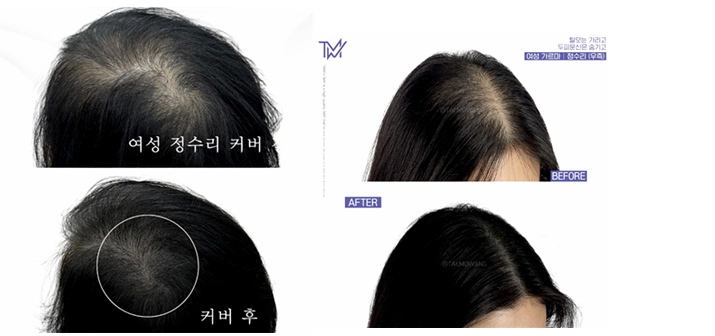 부산머리타투 탈모커버 방법으로 떠오르는 이유