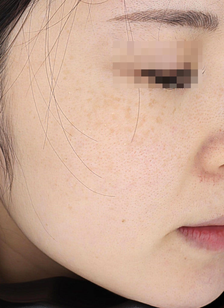  20대 여성, 양측성 오타모반(abnom) 색소 병변 치료 레이저 6회 사진 1064nm nanosec 후기, 당진/서산