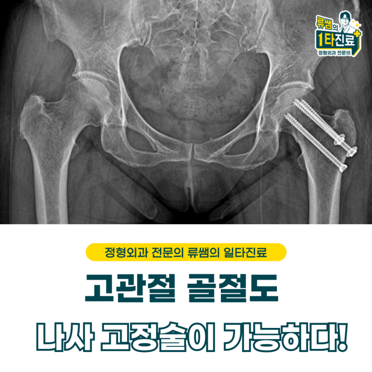  고관절 골절도 인공 관절 수술을 안 할 수 있다.   (의사작성)