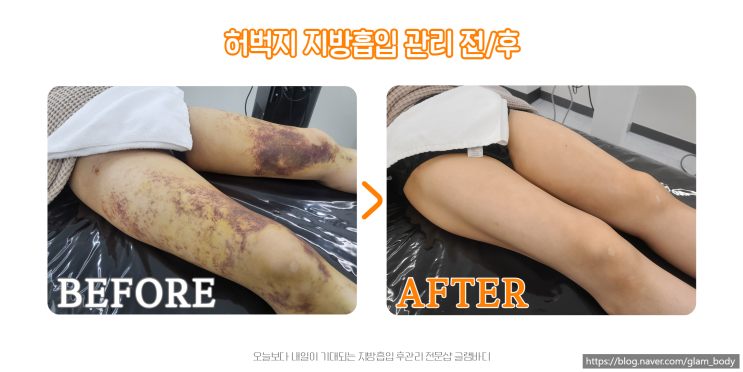  허벅지 지방흡입 후 멍과 붓기, 효과적인 후관리 방법