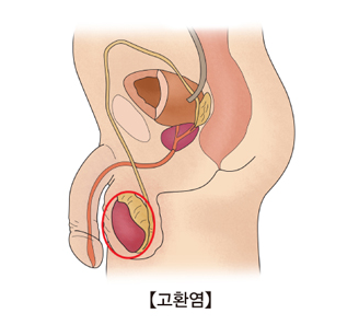 고환염 걸리는 이유와 예방 치료법