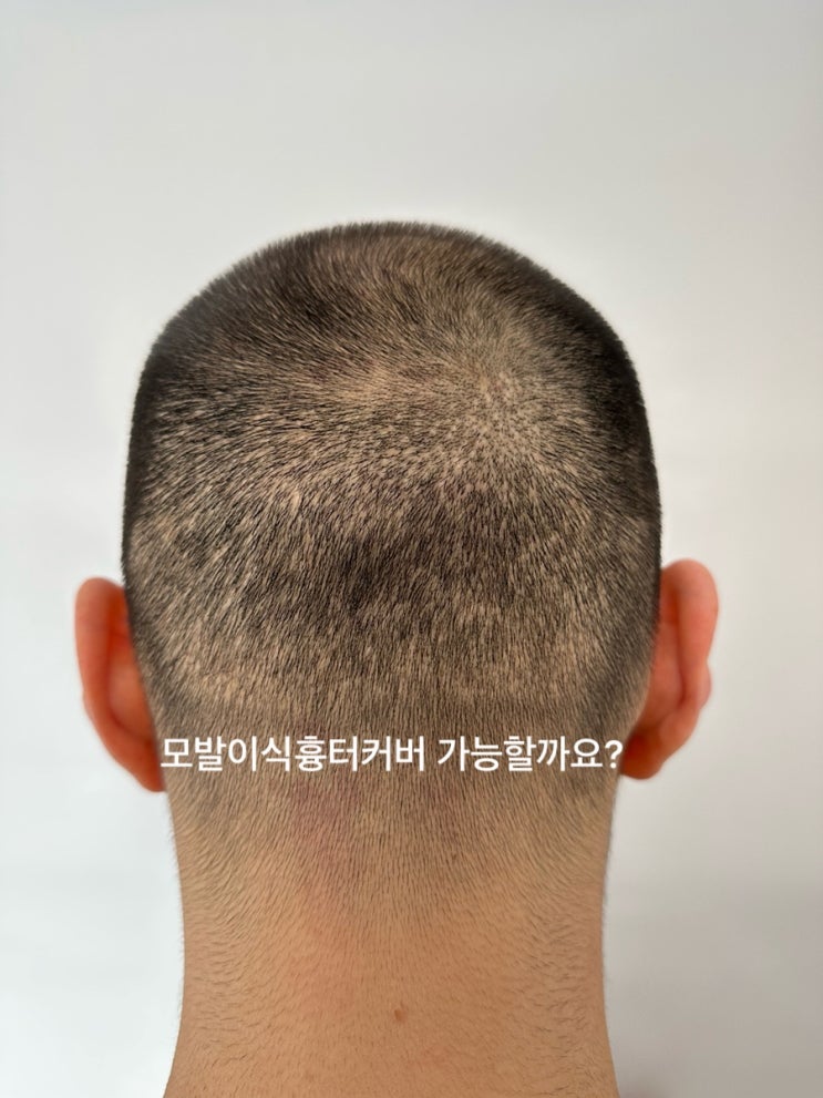  울산삭발 모발이식자국  smp 두피문신으로 흉터커버 1탄