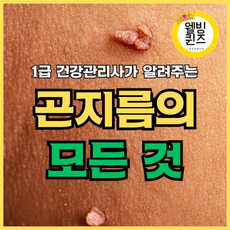곤지름(성기 사마귀) 원인 증상 치료 및 관리 방법 자가테스트