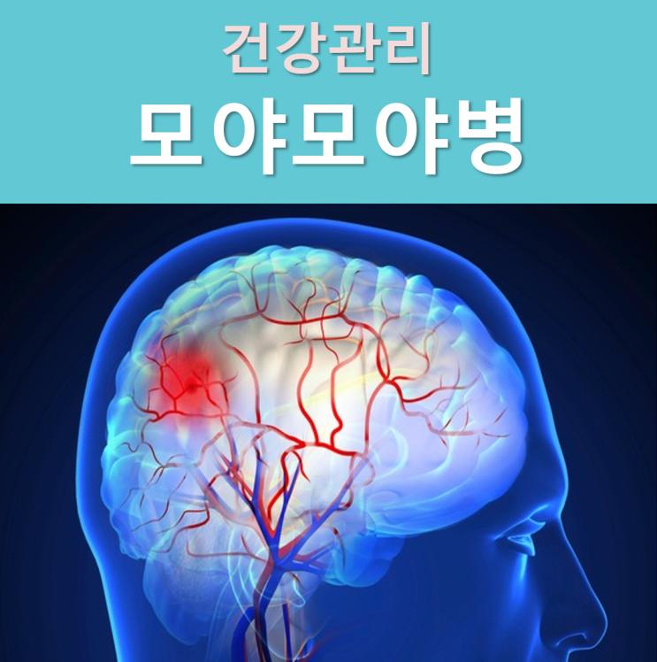  모야모야병 원인과 증상, 수술 후 완치 가능 여부