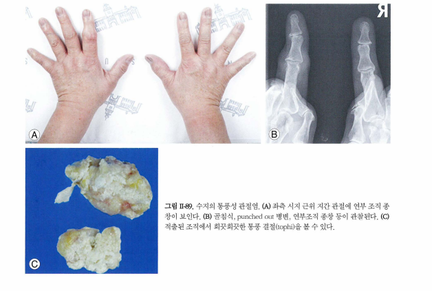 통풍성 관절염과 건선 관절염: 증상과 효과적인 치료 방법