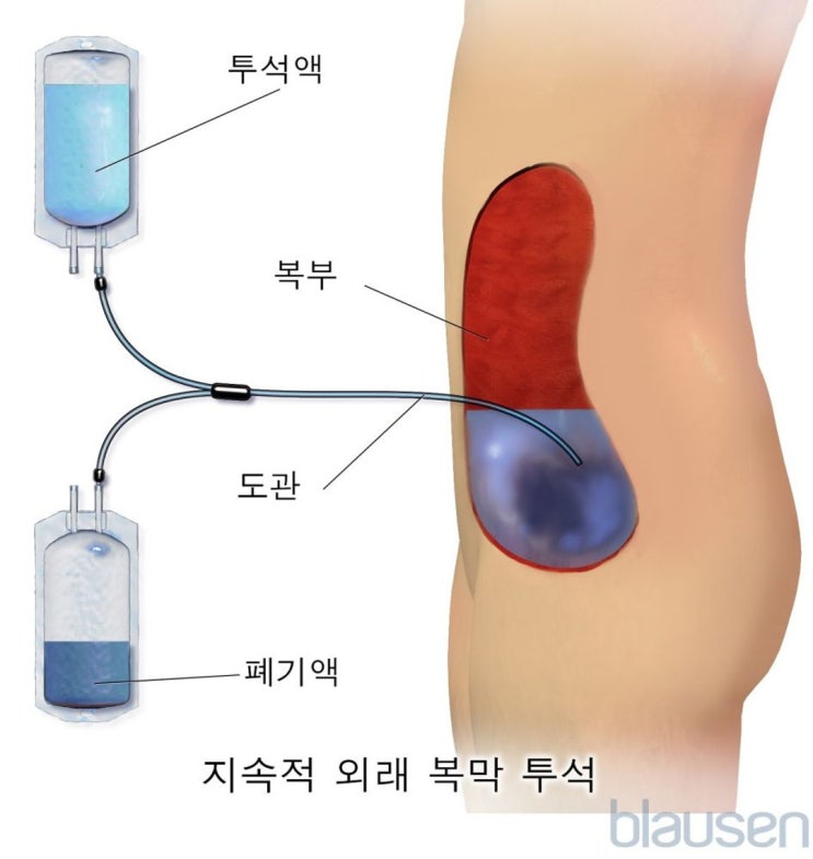 신장병 정기투석의 비용과 그 원리