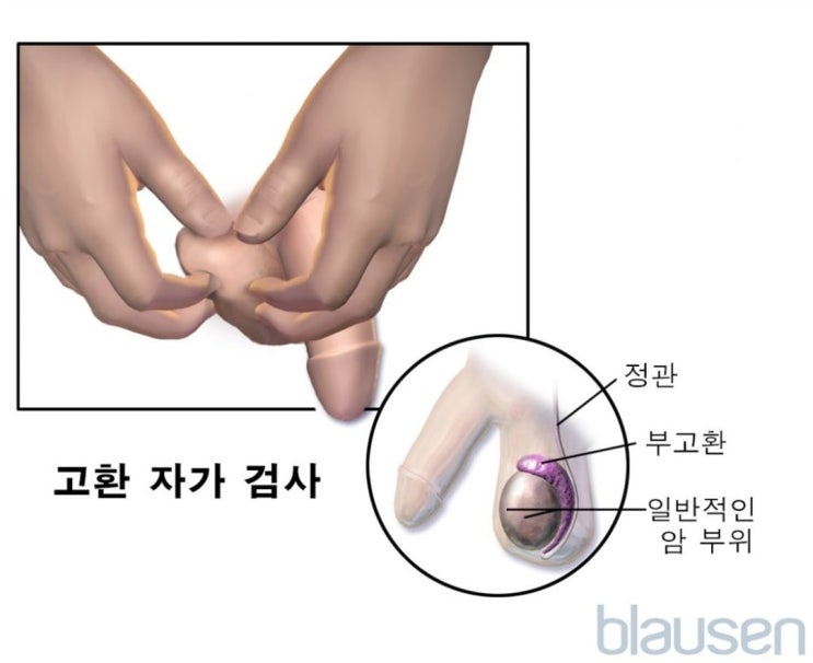 고환암