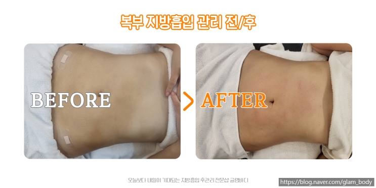  복부 지방흡입 후 바본 관리로 탄탄한 라인 만들기