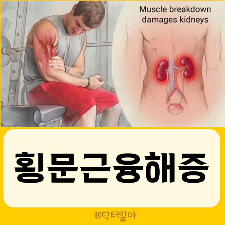  횡문근융해증(Rhabdomyolysis)의 정의, 원인, 증상, 진단 및 치료