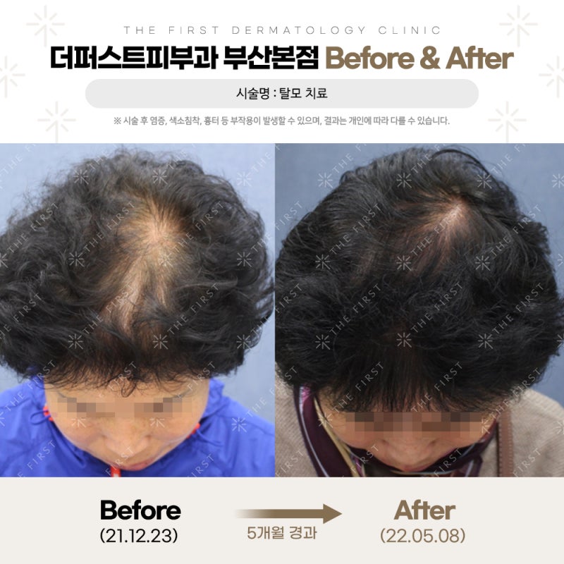 탈모치료 고민 해결! 부산탈모피부과 잘 고르는 법은?