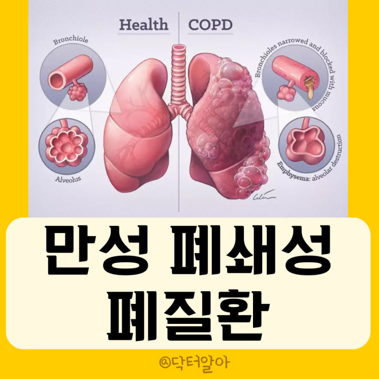  만성폐쇄성폐질환(COPD)의 정의, 원인, 증상, 진단, 치료 및 관찰
