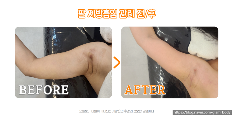  팔지방흡입 후 바본 관리로 최종라인 완성하는 방법