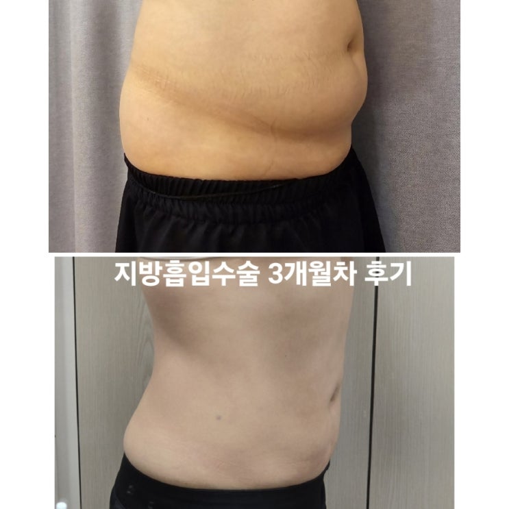  복부지방흡입후기 3개월 바디리프팅 가격, 효과 공유!
