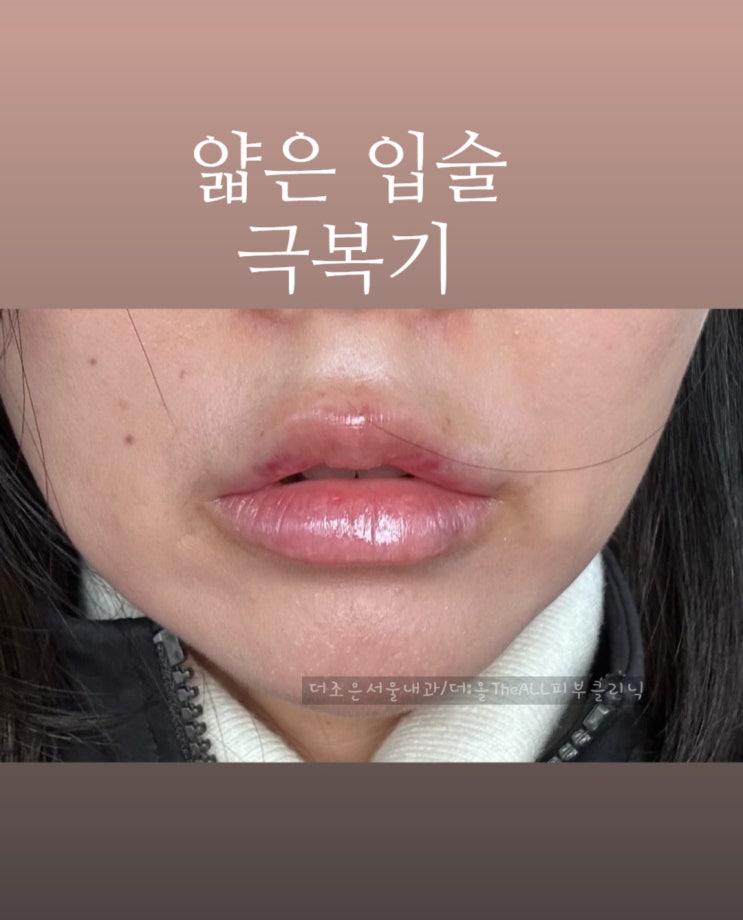 얇은 입술 도톰하게 매력적으로 필러 시술로 변신