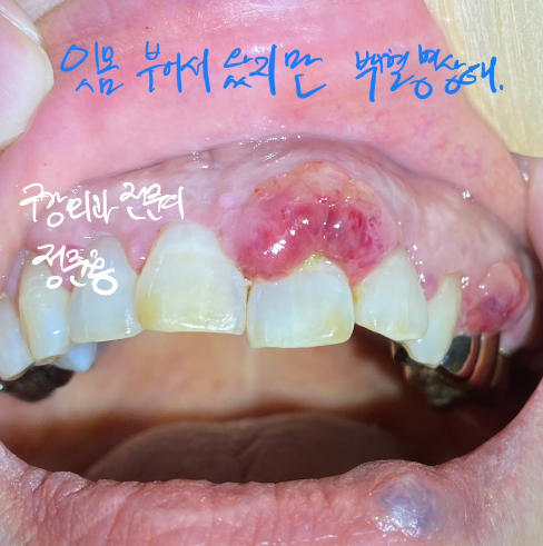  송파구 빨간잇몸? 피멍? 관리방법 알려드립니다