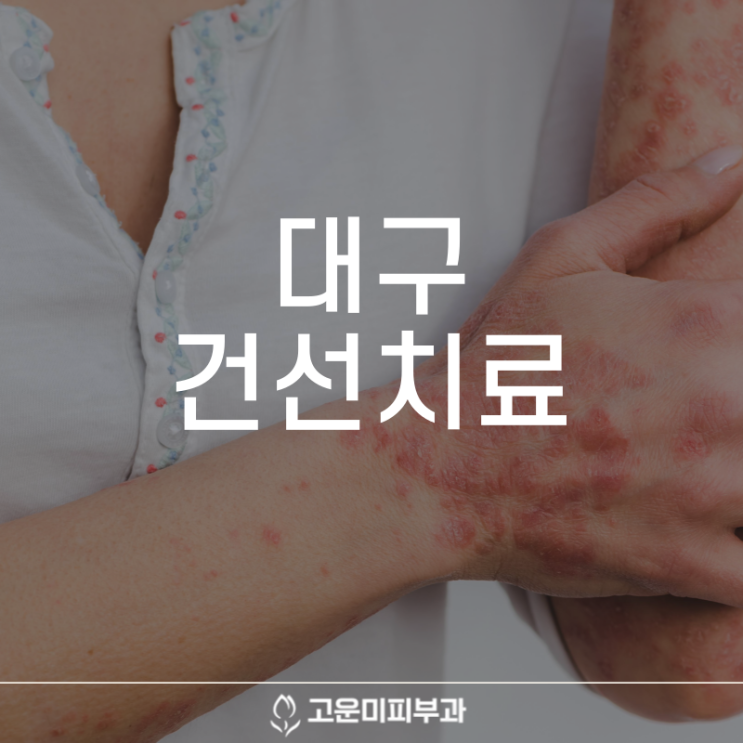  대구건선치료 겨울만 되면 악화되고 재발하는 건선 꾸준한 치료와 관리가 중요합니다