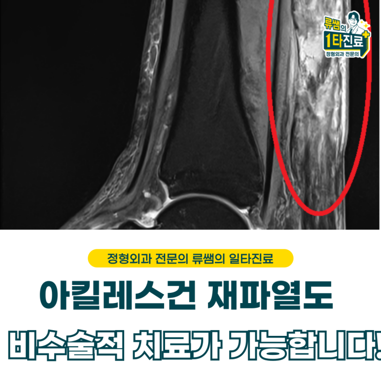  아킬레스건 재파열 원인, 진단 및 비수술적 치료  (의사작성)