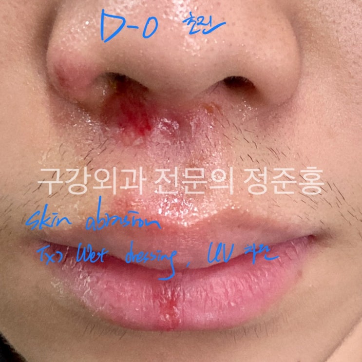  얼굴 상처 병원? 인중, 턱쓸림 등 흉터 치료법 의사가 알려드립니다