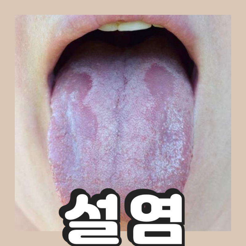 설염 병원 증상 완화방법