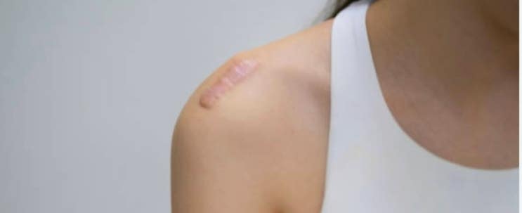 흉터는 어떻게 생기며 왜 지워지지 않을까요?