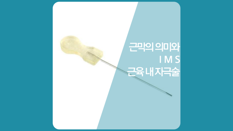  인천허리통증 근막통증증후군 병원-증상, 치료, 주사 대신 사용하는 이것