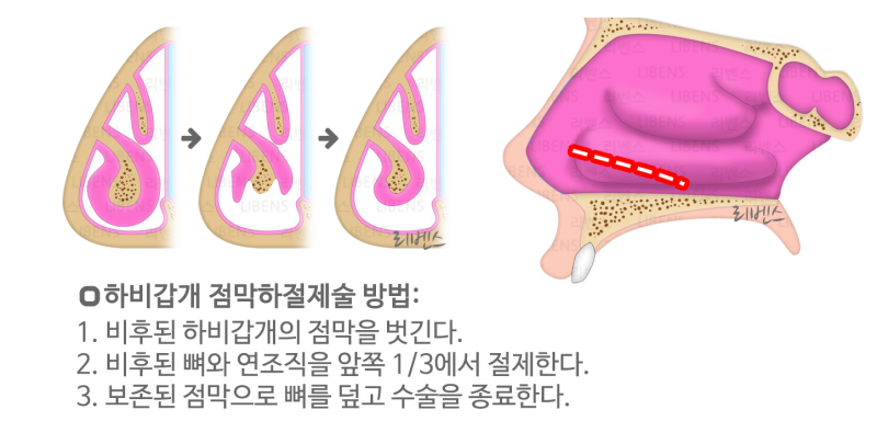 [Q/A]하비갑개 절제술을 받고 싶은데 수술 관련 정보좀 알려주세요~