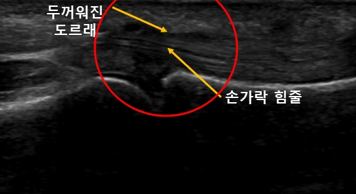  손가락 구부릴 때 통증, 손가락 소리가 계속 나고 뻣뻣해요