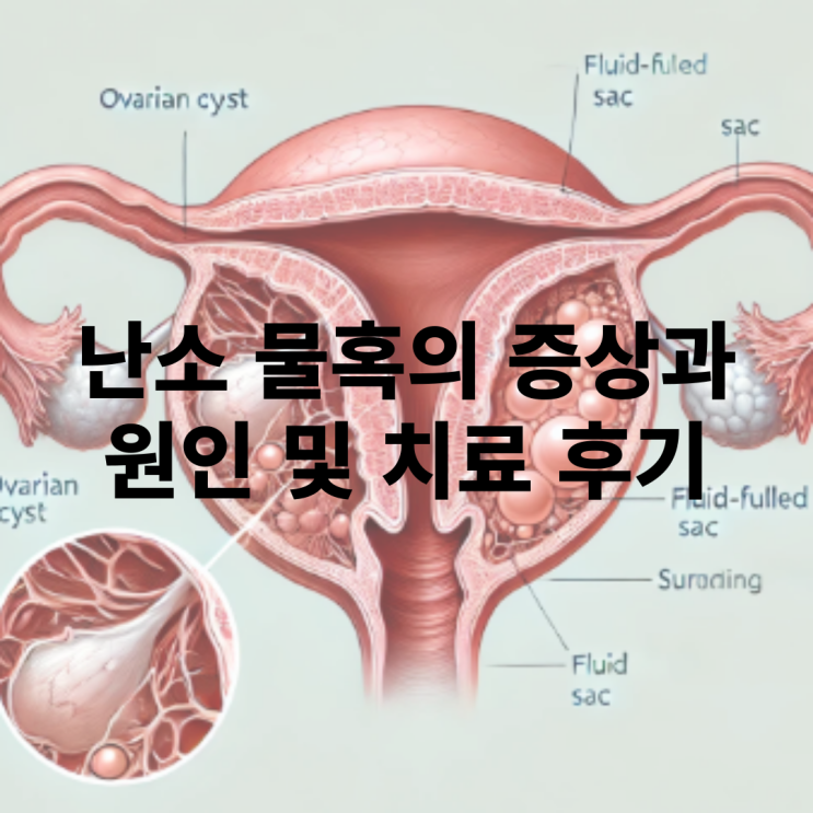  난소 물혹의 증상과 터짐, 원인 및 치료 후기