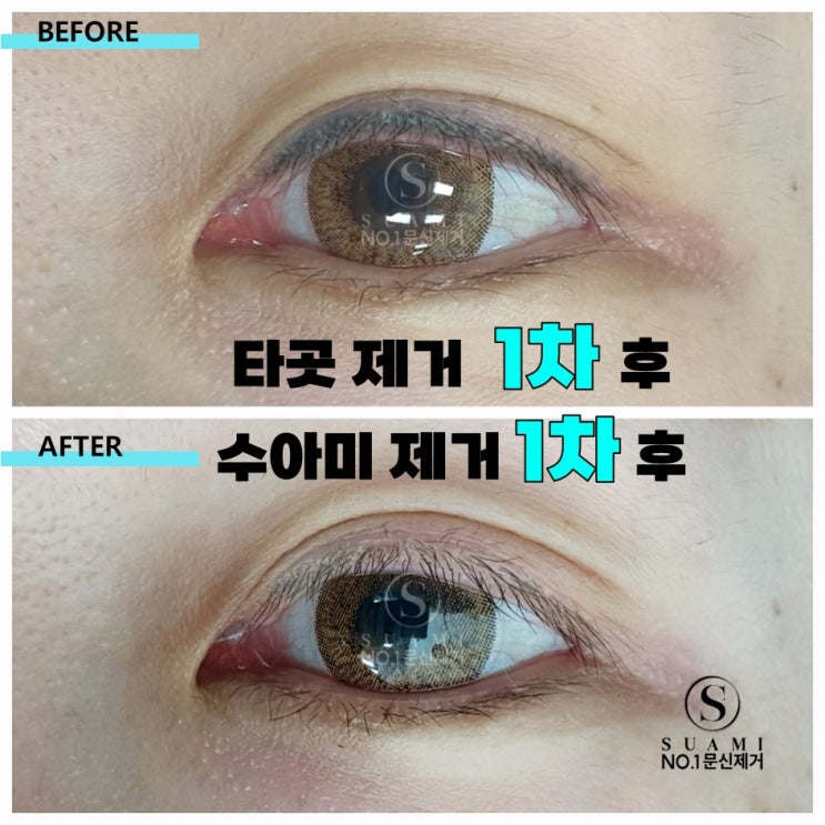  아이라인 제거 2차 시술 내돈내산 후기 [강남 수아미]