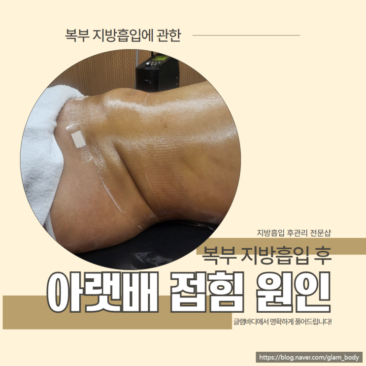  복부 지방흡입 후 아랫배 접힘, 바이오본드 관리 방법.