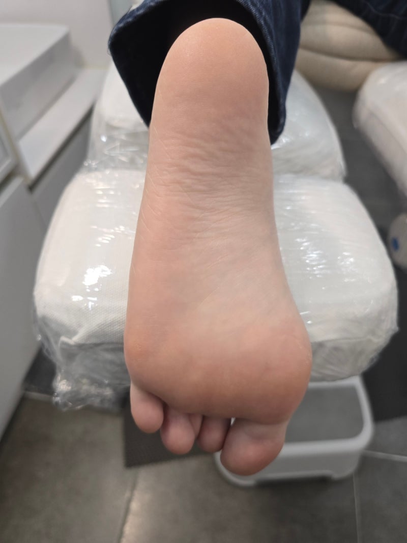 춘천발각질 관리하러 하이푸스 갔다 티눈 제거하고 온 후기