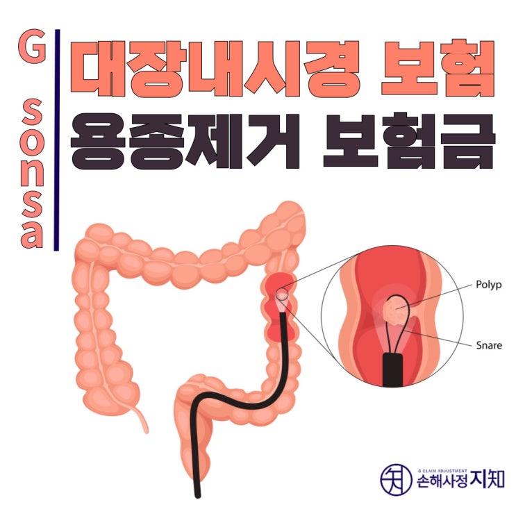  [보험꿀팁] 대장내시경, 용종제거 보험금 총정리