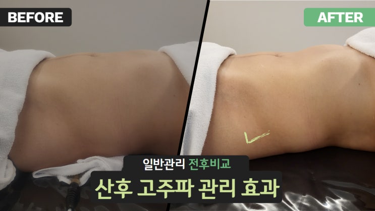  제왕절개 출산 후, 산후 고주파 마사지 효과!