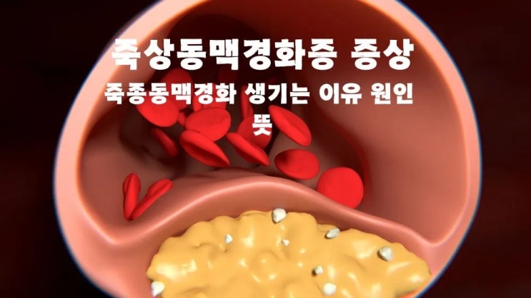  죽상동맥경화증 증상 죽종동맥경화 생기는 이유 원인 뜻