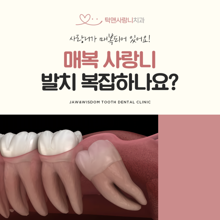  턱앤사랑니치과 사랑니가 매복되어 있는데, 발치가 더 복잡해지나요?