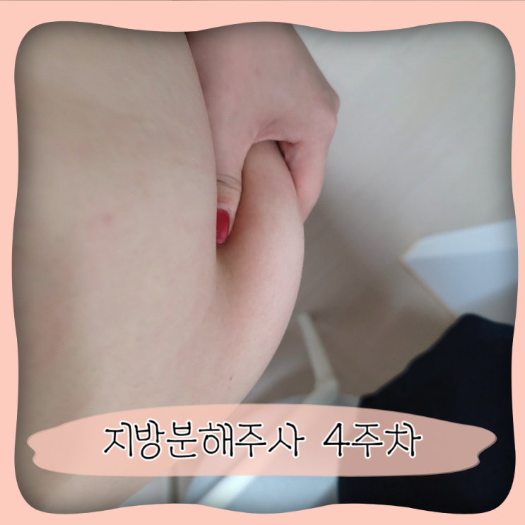  복부 지방분해주사 부작용 ㅣ 4주차 허리라인 변화 후기