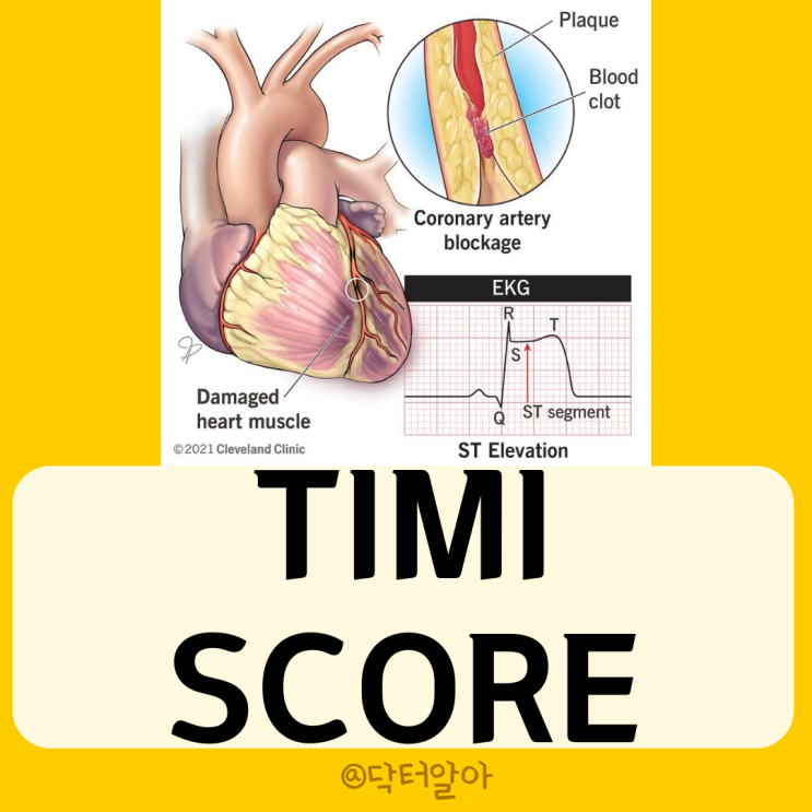  TIMI score의 정의, 채점, 해석, 임상적 사용