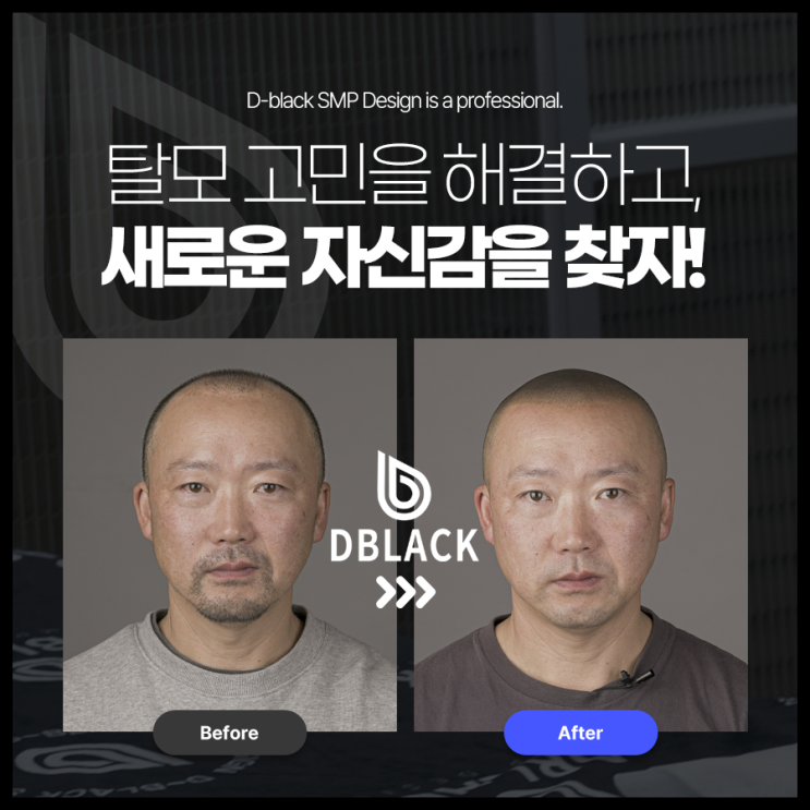  디블랙 두피문신의 종류 SMP ASMP에 대해 알려드리겠습니다. (feat. DBLACK 강남본점)