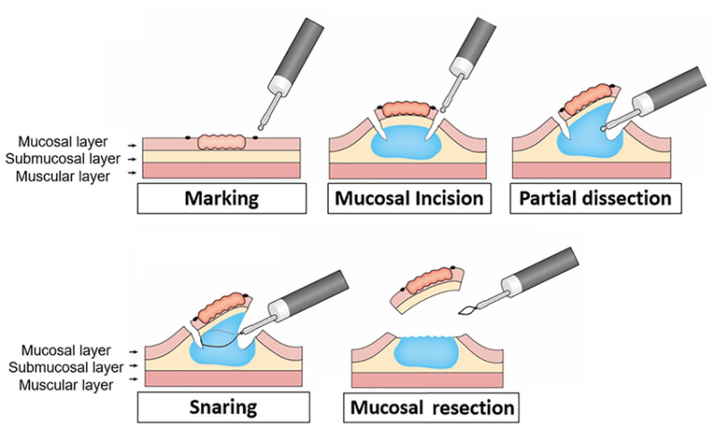 ESD 내시경점막하박리술(Endoscopic Submucosal dissection) : 네이버 블로그