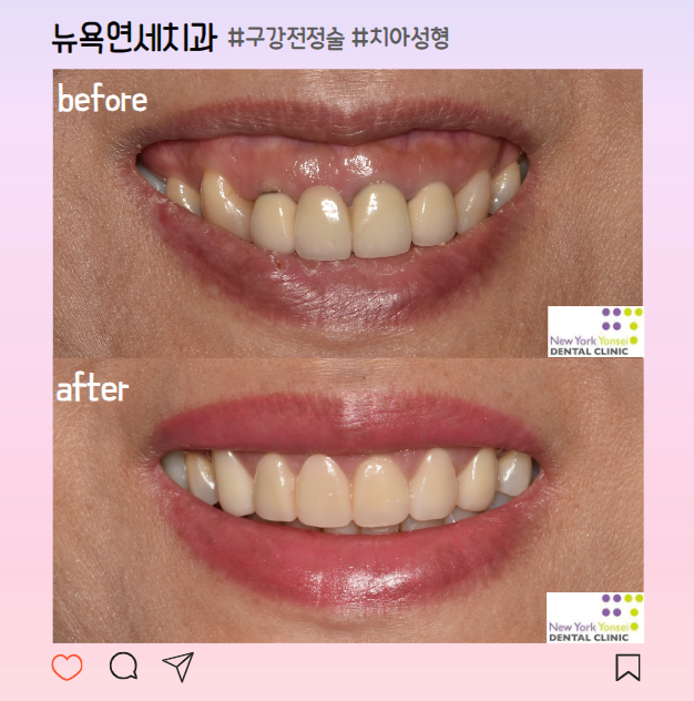  앞니 크라운 올세라믹과 잇몸성형으로 거미스마일 해결
