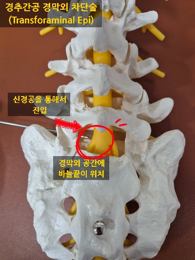 [비수술적 치료] 주사치료, 신경차단술의 종류(1) - (2편)