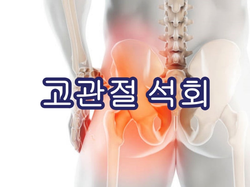 고관절 석회 원인 증상 및 해결법 알려드립니다